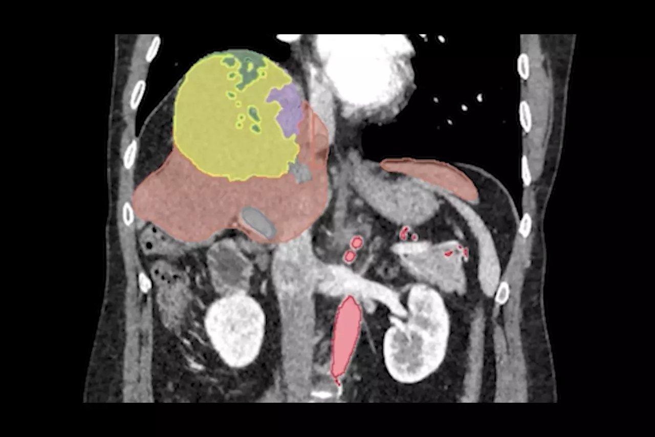 Annotated CT scan slice with segmented organs